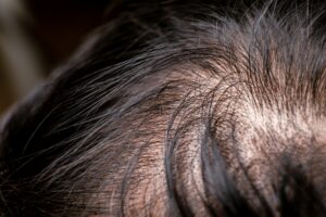 perte cheveux calvitie