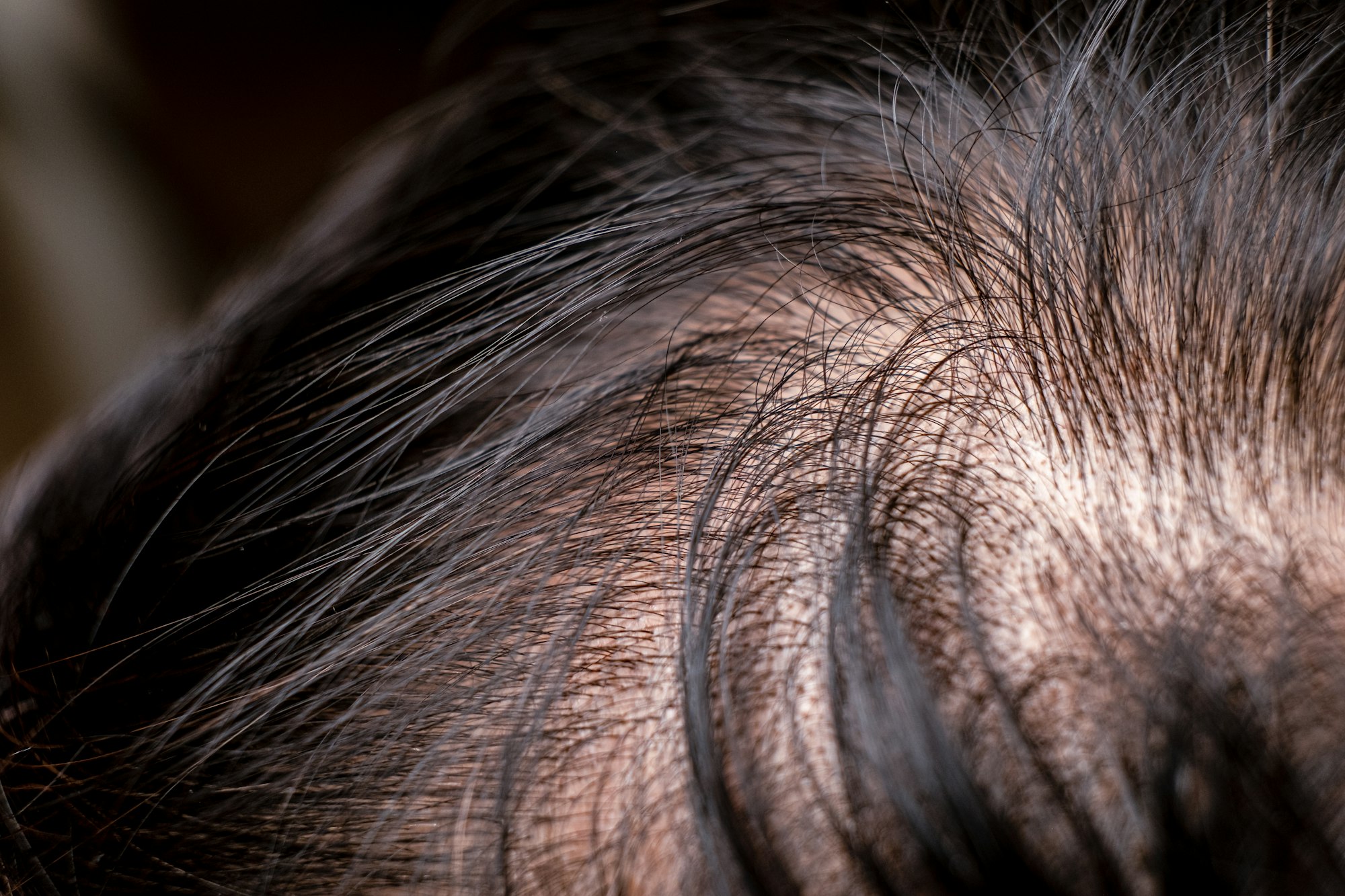 perte cheveux calvitie