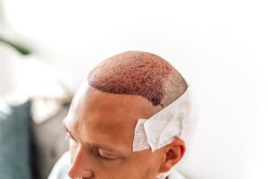 greffe cheveux