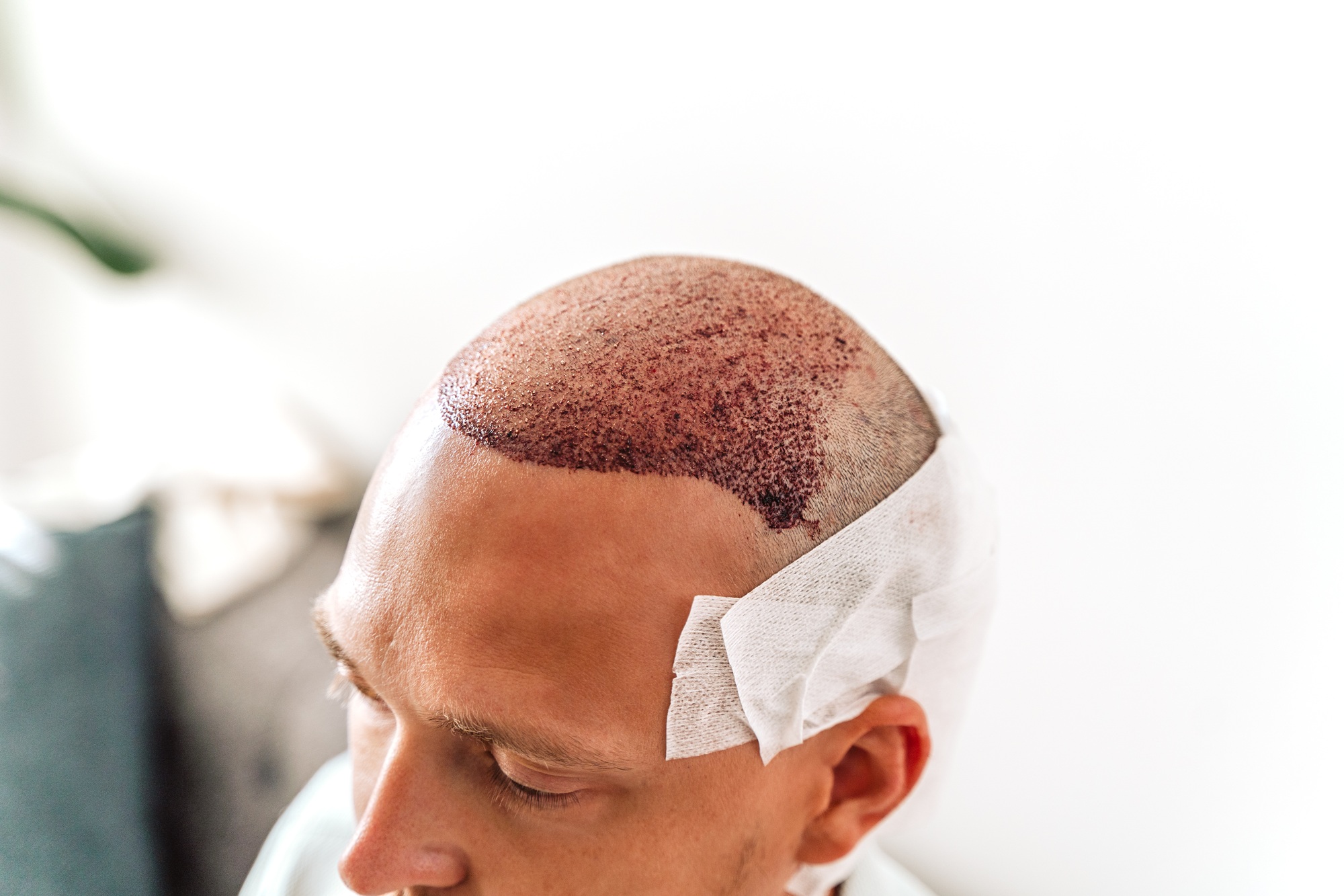 greffe cheveux