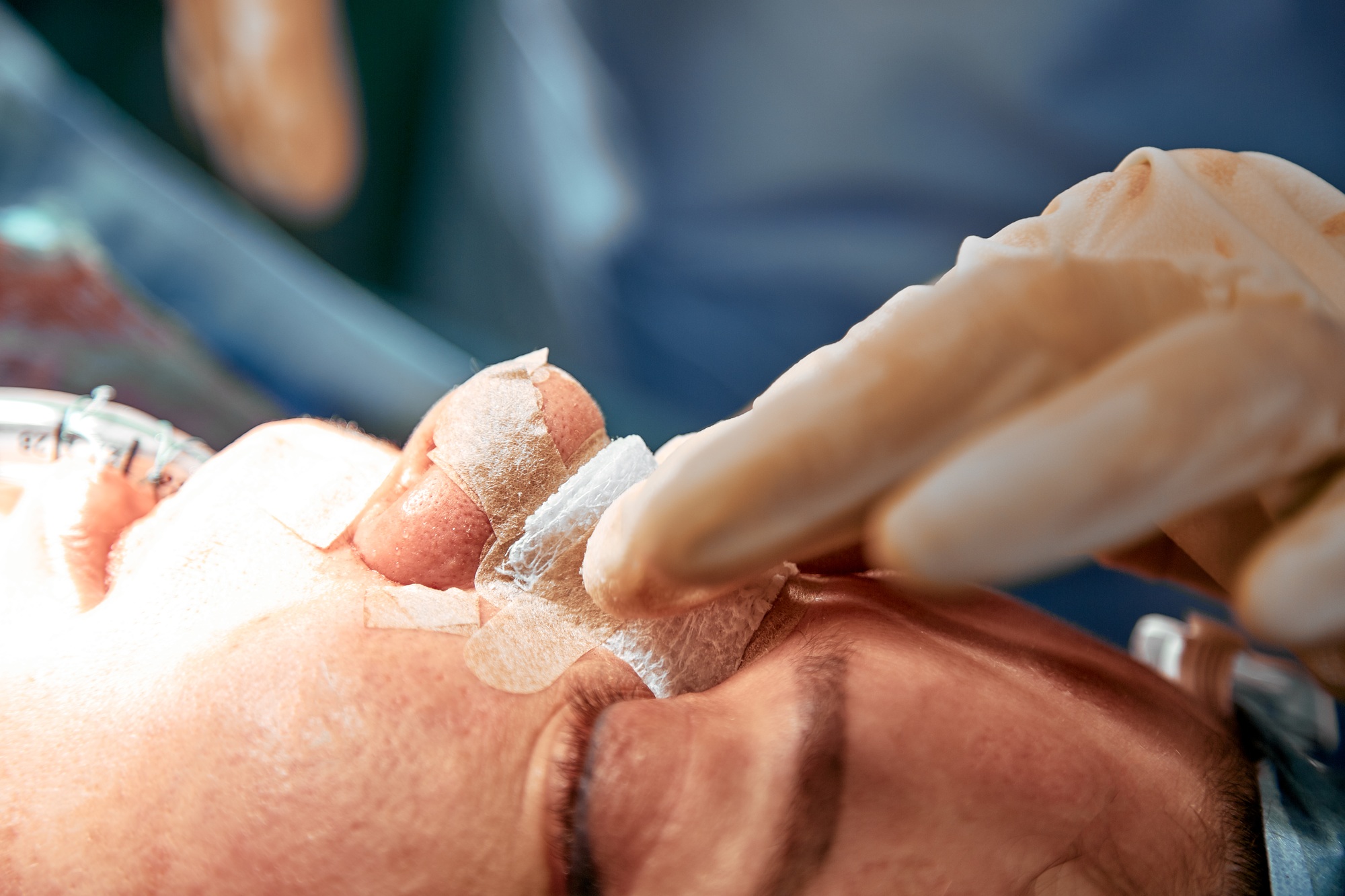 Rhinoplasty close-up. An operating team of several doctors performs nose surgery. Curved septum