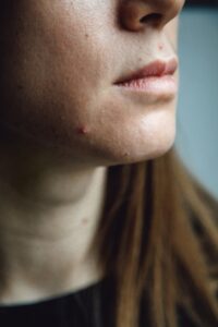bouton acide salicylique